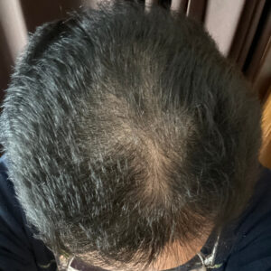 薄毛改善の検証実験開始より6ヶ月経過後　頭頂部状態　画像